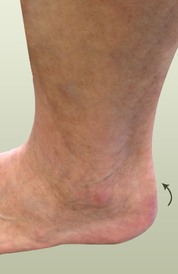 Achilles Spur After Surgery - University Foot and Ankle Institute