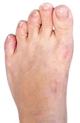 Bunion Revision Surgery, Failed Bunion Surgery, University Foot and Ankle Institute, Bunion Surgeon Los Angeles