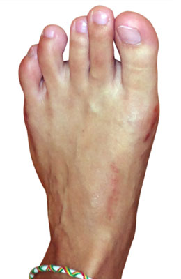 Lapidus Forever Bunionectomy, UFAI, Before and after Bunion Surgery Pictures, Dr. Baravarian