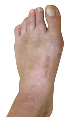 Lapidus Bunionectomy Hammertoe Correction Before Image University Foot and Ankle Institute