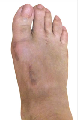 Lapidus Bunionectomy, Tailor's Bunion, Neuroma, After Picture, University Foot and Ankle Institute