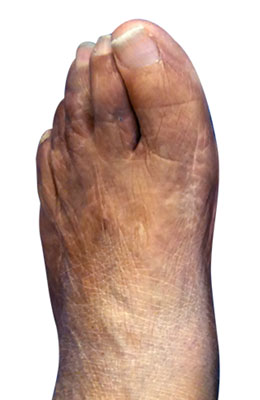 Severe bunion and hammertoe and tailors bunion after image, university foot and ankle institute