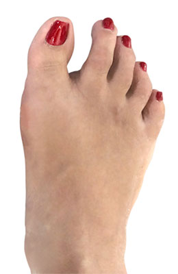 Bunion and Tailors Bunion, After mage, University Foot and Ankle Institute
