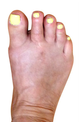 Osteotomy Bunionectomy, Hammertoe and Plantar Plate Repair,  after images