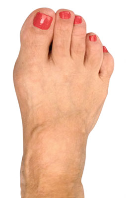 Osteotomy Bunion Surgery, University Foot and Ankle Institute, After Picture
