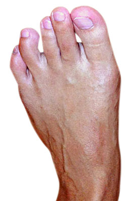 Bunion Osteotomy Surgery After Picture  - University Foot and Ankle Institute