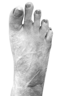 Bunion After Surgery - University Foot and Ankle Institute, Osteotomy Bunionectomy