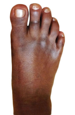 Lapidus Bunionectomy, Hammertoe Correction, Osteotomy Tailors Bunion Surgery After Picture