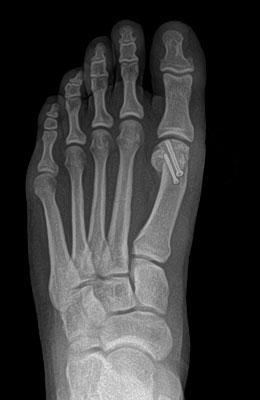 Bunion After Surgery Picture - University Foot and Ankle Institute