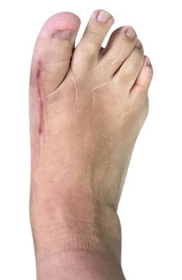 Revision Hallux Varus After Picture, University Foot and Ankle Institute