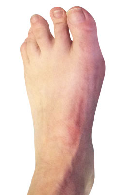 Bunion Surgery After Picture, University Foot and Ankle Insitute, Lapidus Bunionecotmy Procedure