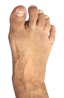 Bunion Surgery After Picture, UFAI, Lapidus Bunionectomy
