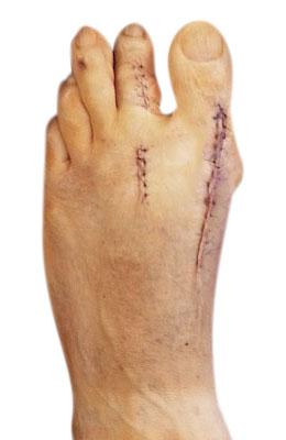 Bunion Revision Surgery After Picture, University Foot and Ankle Institute