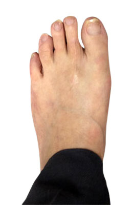 Osteotomy Bunion Surgery Six Weeks After