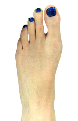 Bunion Correction Surgery - Osteotmoy Bunionectomy - After Picture