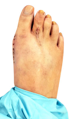 Osteotomy Bunionectomy and Plantar Plate Repair After Surgery Picture
