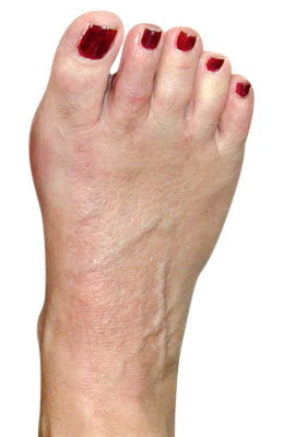 Bunion with Crossover After Surgery - University Foot and Ankle Institute