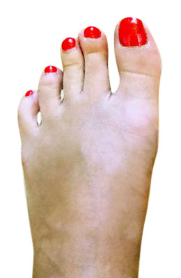 Bunion Correction with Lapidus Procedure After Picture, University Foot and Ankle Institue