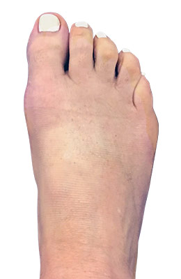 Hammertoe Correction with Bunion Correction After Surgery Picture