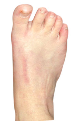 Bunion, Lapidus Bunionectomy After Surgery - University Foot and Ankle Institute