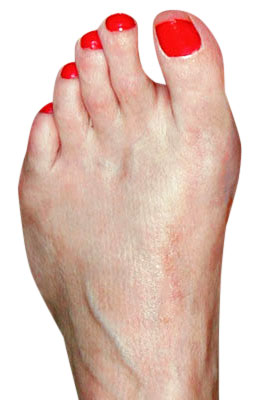 Bunion Osteotomy After Surgery - University Foot and Ankle Institute