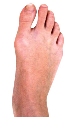 Osteotomy Bunion After Surgery - University Foot and Ankle Institute
