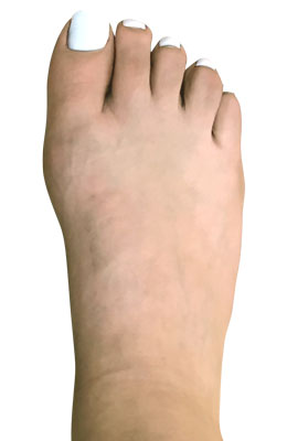 Forever bunionectomy, Before and after bunion pictures, Los Angeles bunion surgeon