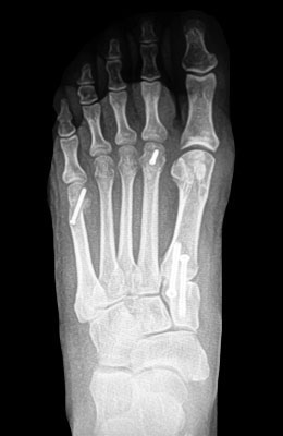 Lapidus Bunionectomy with Weil Procedure After Surgery - University Foot and Ankle Institute