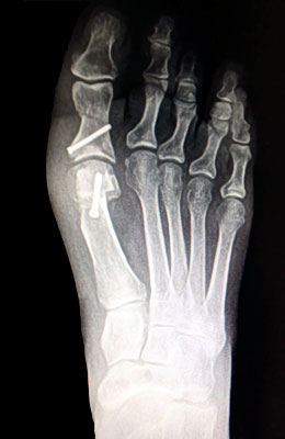 Austin Bunionectomy with Akin Procedure After Surgery - University Foot and Ankle Institute