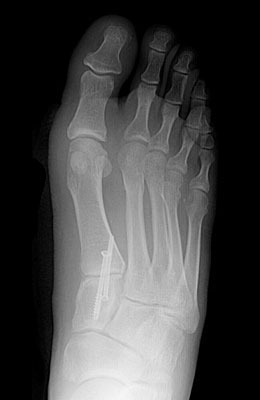 Bunion After Surgery, Lapidus Bunionectomy  - University Foot and Ankle Institute