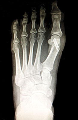 Small Bunion After Surgery - University Foot and Ankle Institute