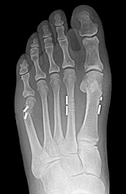 Tightrope Procedure and Osteotomy Tailors Bunion Surgery After Surgery - University Foot and Ankle I