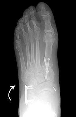 Flat Foot After Surgery - University Foot and Ankle Institute
