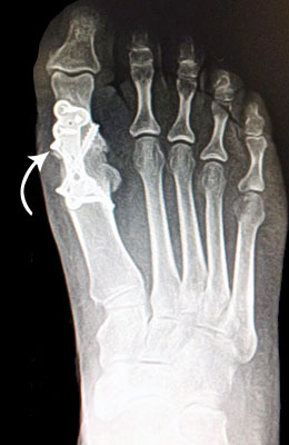 Fusion After Surgery - University Foot and Ankle Institute