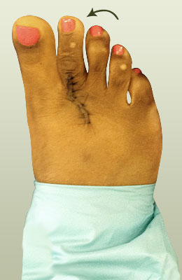 Plantar Plate Surgery After Picture, University Foot and Ankle Institute