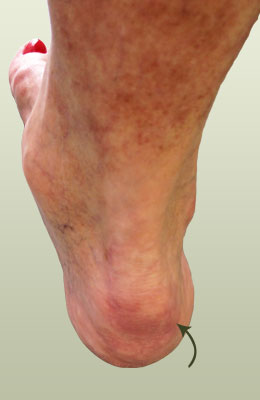 Achilles Spur Befor Surgery - University Foot and Ankle Institute