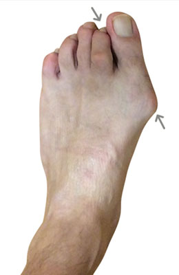 Lapidus Bunionectomy Hammertoe Correction After Image University Foot and Ankle Institute