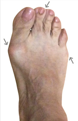 Lapidus Bunionectomy, Tailor's Bunion, Neuroma, Before Picture, University Foot and Ankle Institute