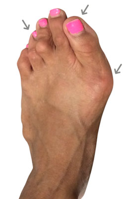 Failed bunion revision surgery before picture, University Foot and Ankle Institute