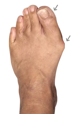 Minvasive Bunionectomy and hammertoe correction, University Foot and Ankle Institute