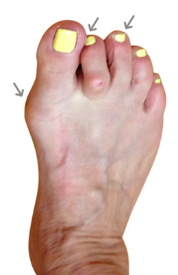 Osteotomy Bunionectomy, Hammertoe and Plantar Plate Repair, before and after images
