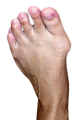 Bunion Osteotomy Surgery Before Picture - University Foot and Ankle Institute