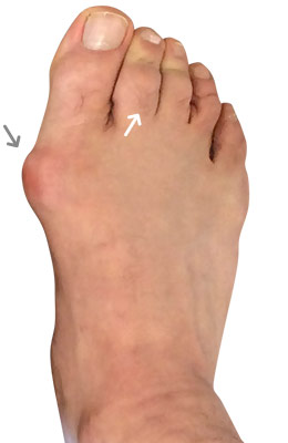 Bunionectomy and Plantar Plate Tear Before Image, UFAI