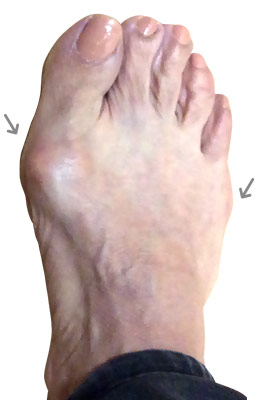 Lapidus Bunionectomy and Neuroma Removal Before and After Picture, UFAI