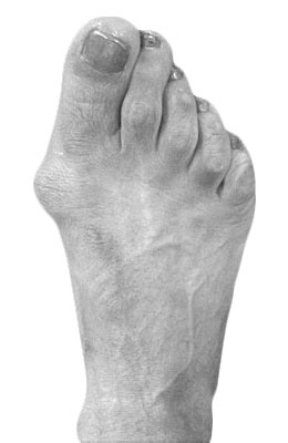 Bunion Before Surgery - University Foot and Ankle Institute, Osteotomy Bunionectomy