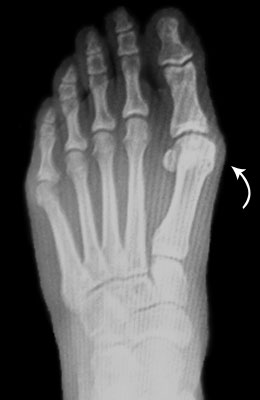 Bunion Before Surgery Picture - University Foot and Ankle Institute