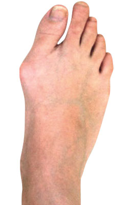 Osteotomy Bunion Before Surgery - University Foot and Ankle Institute