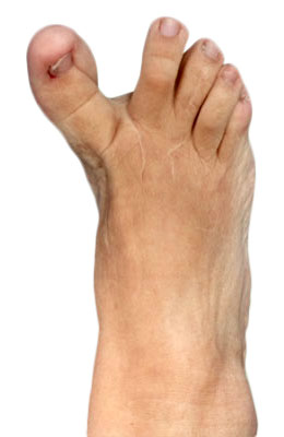 Revision hallux Varus Before Picture, University Foot and Ankle Institute