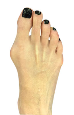 Bunion and Tailors Bunion Surgery Before Picture, University Foot and Ankle Institute