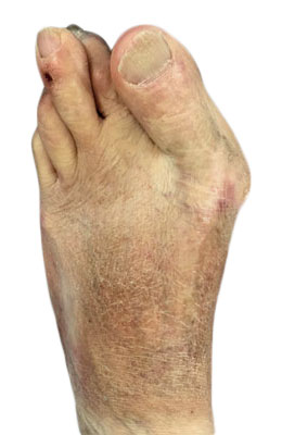 Bunion Revision Surgery Before Picture, University Foot and Ankle Institute